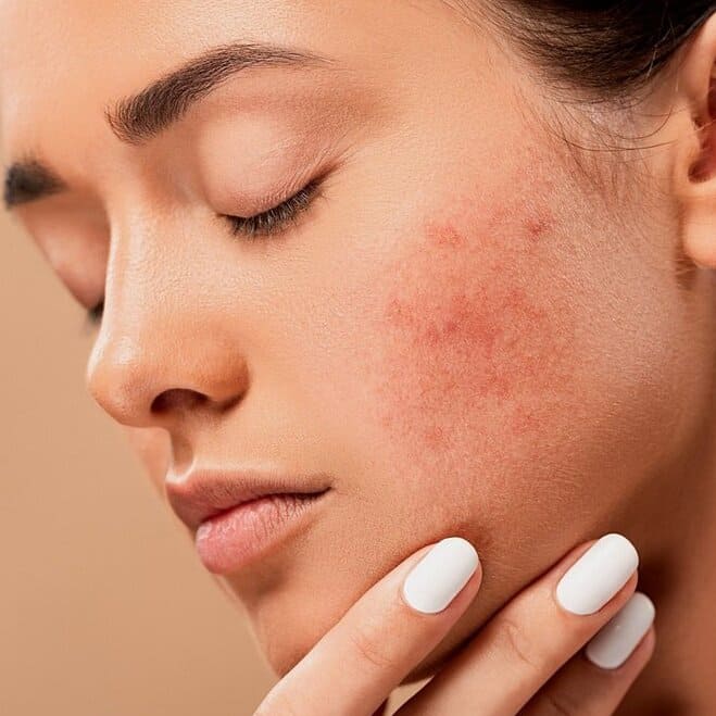 prevents acne